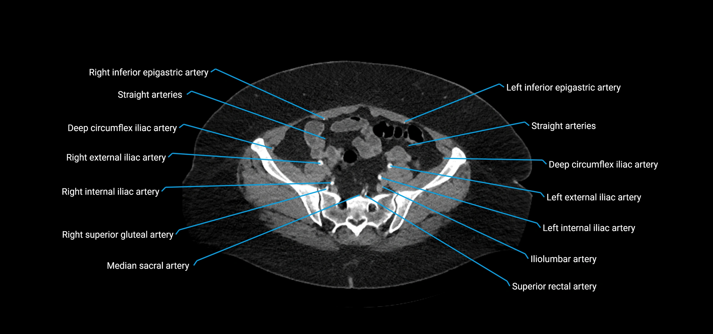 CTA abdomen axial cross sectional anatomy labelled image_195 (2).webp